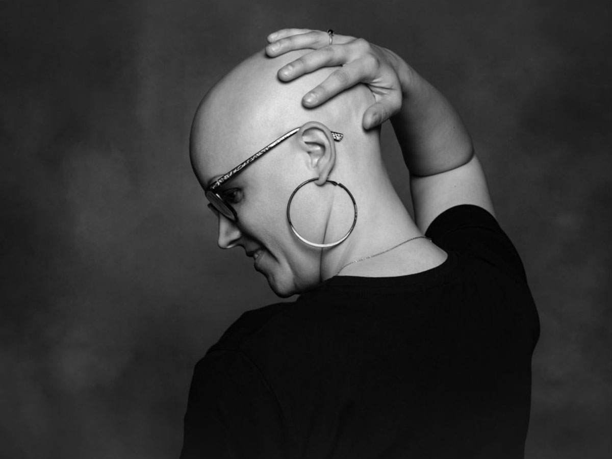 Alopecia en mujeres
